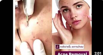 Acne Extraction by Laser at Yoskarn, Thailand