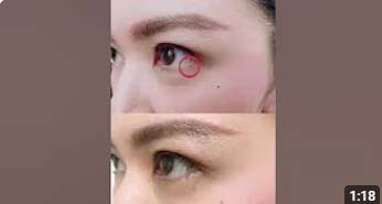 Laser fat removal under the eyes⁣