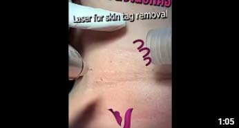 Laser for skin tag removal 