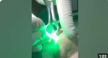 Laser treatment for allergies