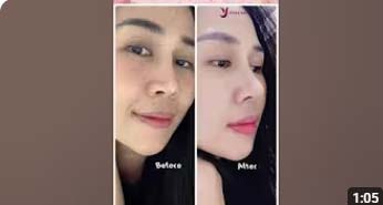 Nose correction surgery